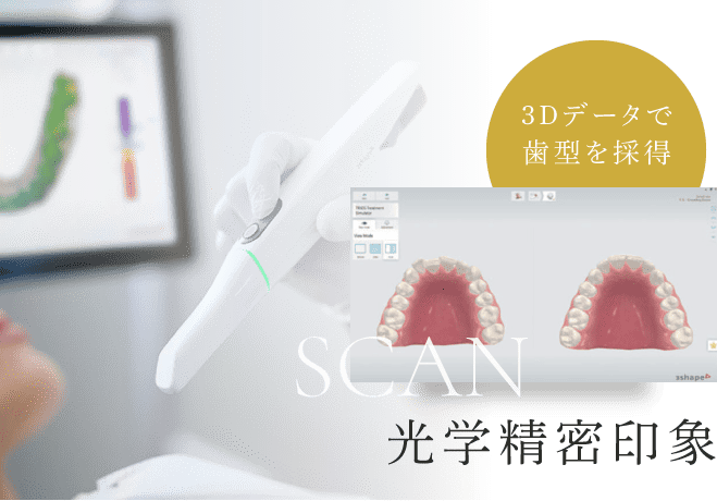 光学精密印象　3Dデータで歯型を採得