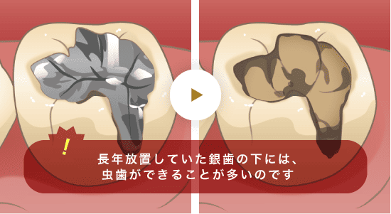 長年放置していた銀歯の下には、虫歯ができることが多いのです